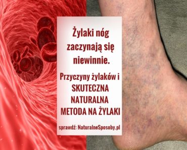 NaturalneSposoby.pl-zylaki-nog-przyczyny-zdjecia-domowy-sposob-na-zylaki-naturalny-przepis