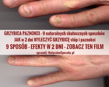 naturalnesposoby.pl-grzybica-paznokci
