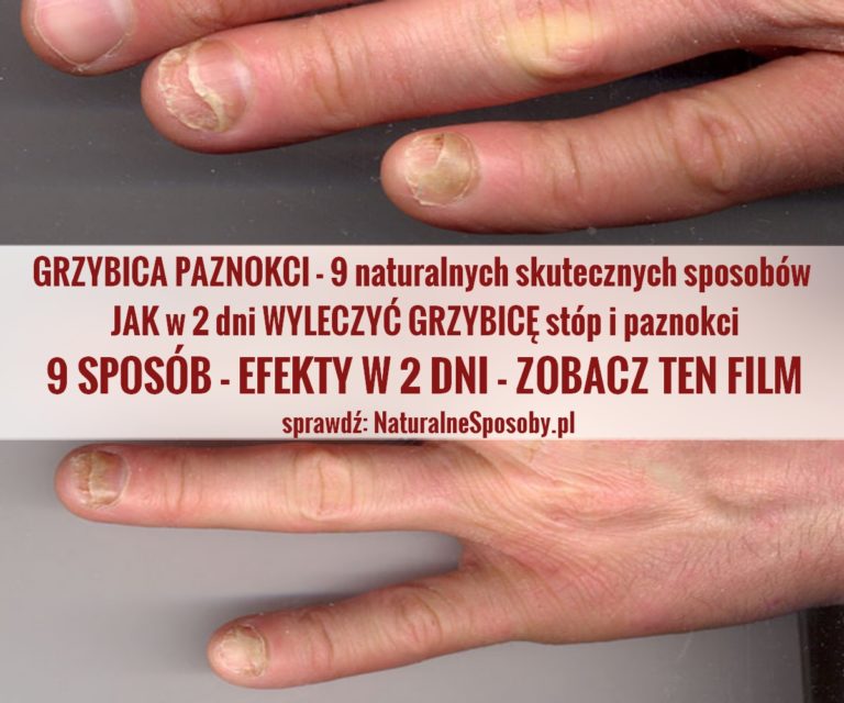 GRZYBICA PAZNOKCI JAK w dni WYLECZYĆ GRZYBICĘ stóp i paznokci i naturalnych sposobów